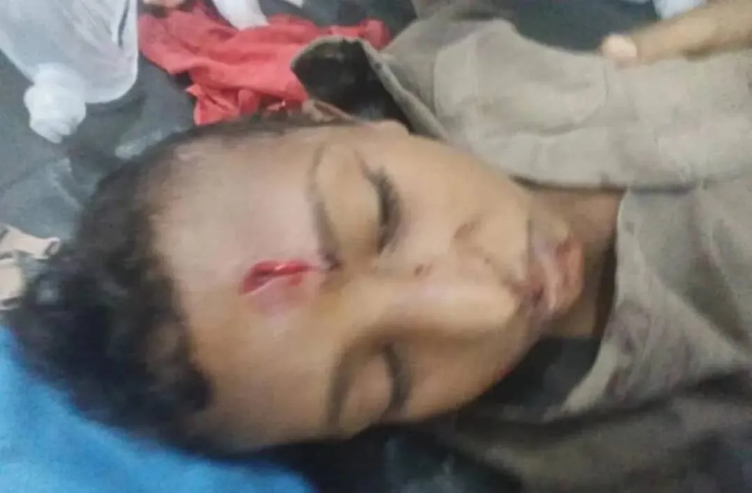 إصابة طفل بانفجار مقذوف من مخلفات الحوثيين جنوب الحديدة